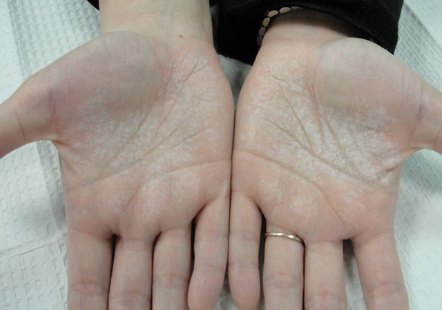 皮肤变化倾向于具有清晰的边界并且通常是对称的,即在两个手掌有类似
