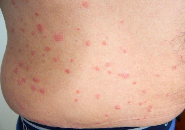 银屑病初期症状:明显的皮疹边界,存在剥离,在摩擦时增加.