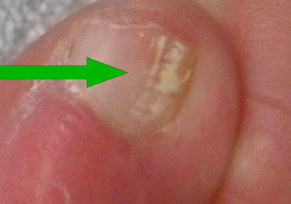 白色浅表灰指甲的初期症状图片