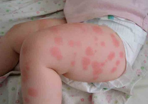 宝宝慢性特发性荨麻疹症状图片