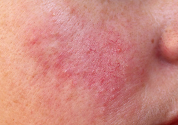常见皮肤病红斑痤疮症状图片