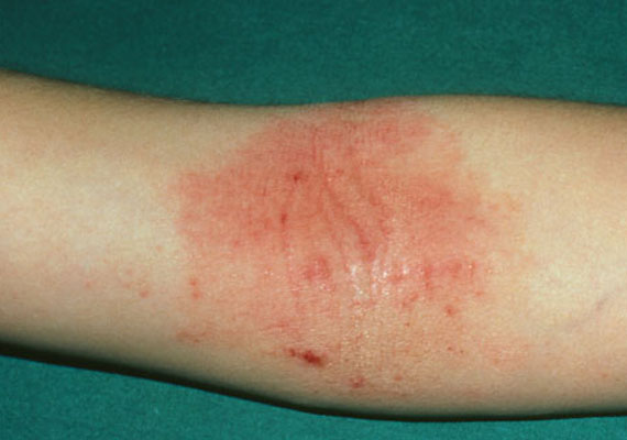 常见皮肤病湿疹症状图片
