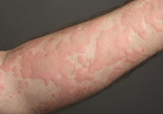 常见皮肤病荨麻疹症状图片