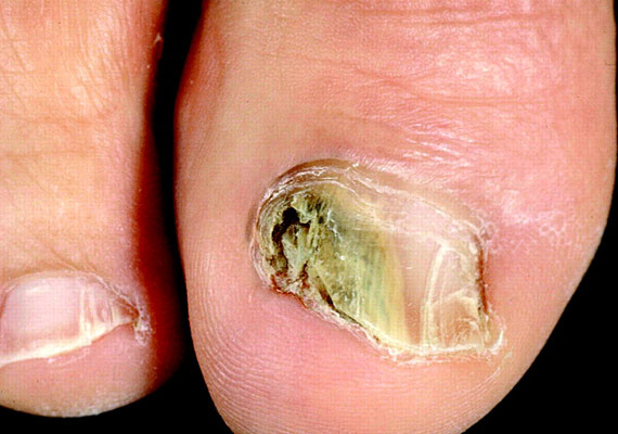 常见皮肤病真菌指甲感染症状图片