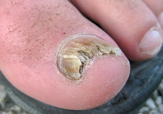 大脚趾灰指甲图片