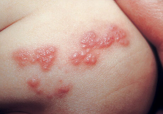 带状疱疹会感染多长时间