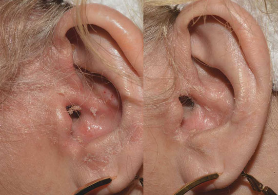 耳部寻常型银屑病好转症状对比图片