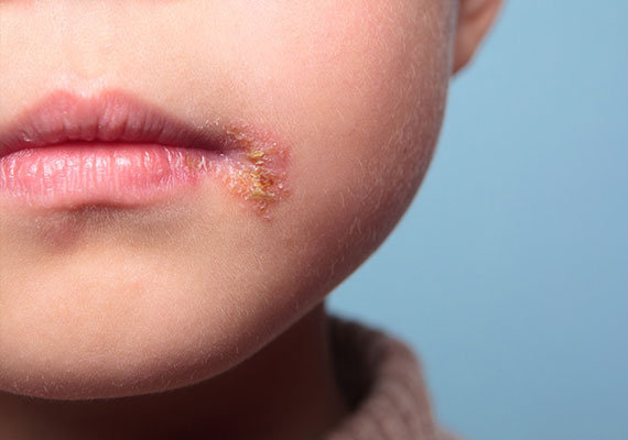 儿童常见皮肤病的种类图片脓疱疮