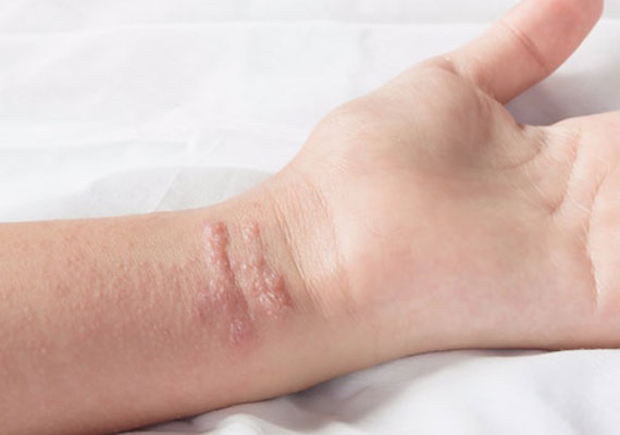 关节的皮肤瘙痒刺激性接触性皮炎