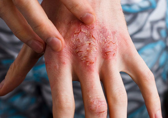 关节的皮肤瘙痒可能是湿疹
