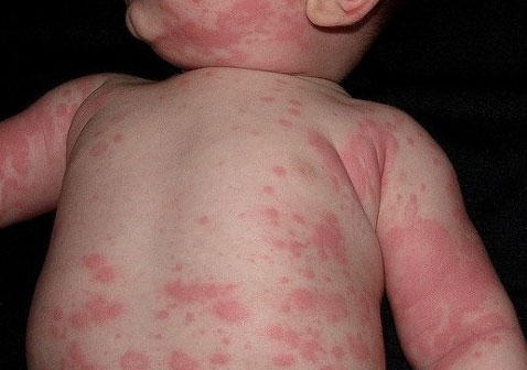 儿童荨麻疹多久能好