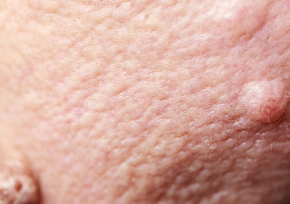 关节的皮肤瘙痒皮肤纤维瘤