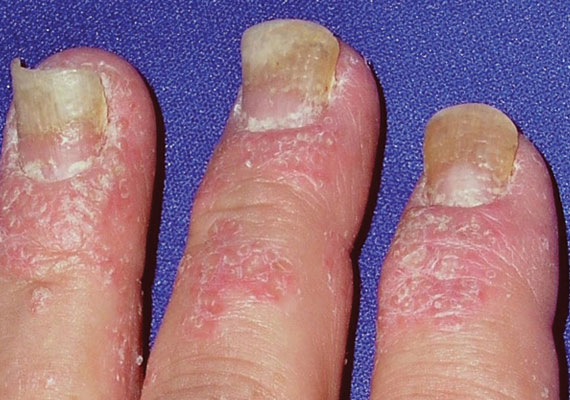 关节型银屑病初期症状指甲变化图片