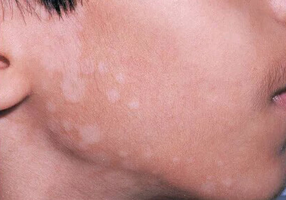 汗斑是什么传染吗
