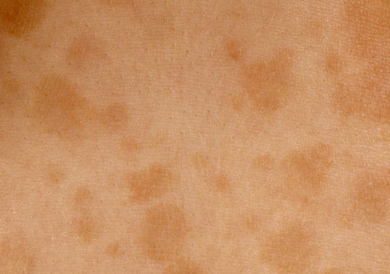 汗斑早期图片症状为斑点