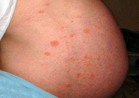 怀孕期间荨麻疹图片