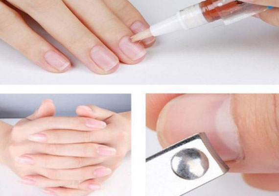 灰指甲初期治疗方法