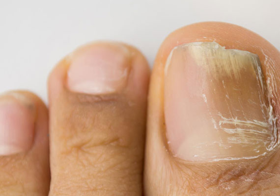 灰指甲早期症状图片