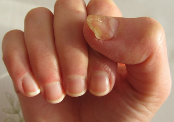 手指灰指甲症状图片