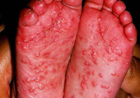 脚底发生脓疱型银屑病的图片