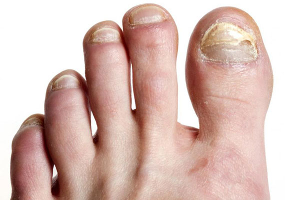 脚趾灰指甲的症状前兆指甲变色