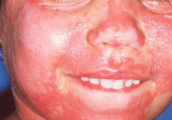 面部红皮型银屑病症状图片