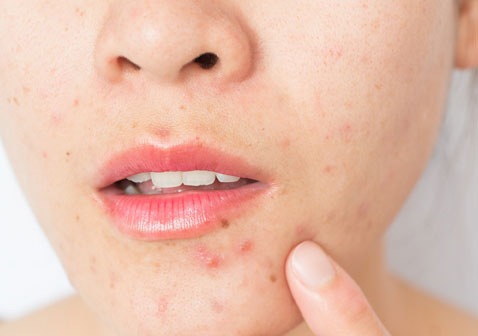 敏感性皮肤痤疮最佳治疗方法