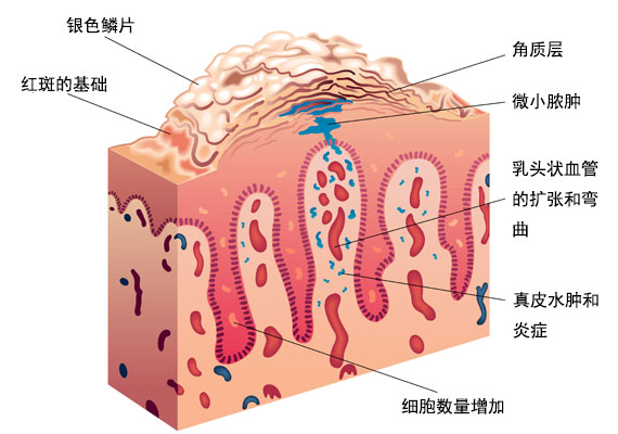 牛皮癣是怎么形成的复杂过程图片