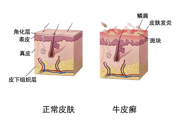 牛皮癣是怎么形成的简单过程图片