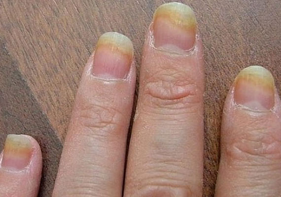 牛皮癣症状指甲增厚图片