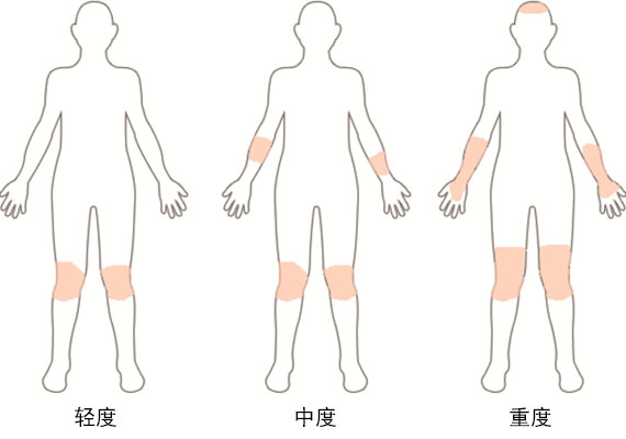 牛皮癣症状轻重示意图