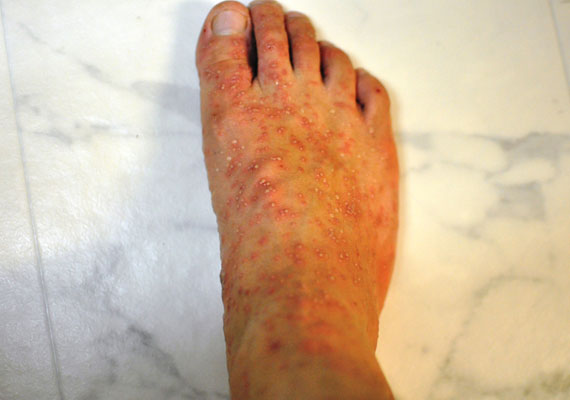 脚部脓疱型银屑病的样子如何治疗