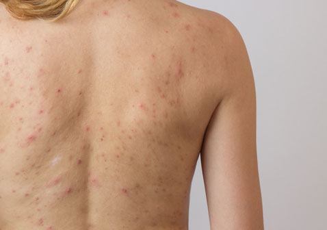 女性背部长痘痤疮的原因