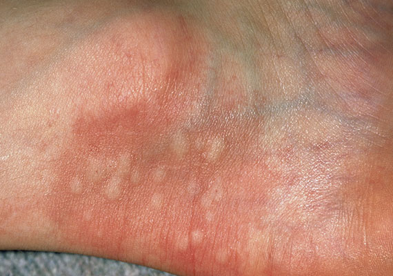 皮肤病的种类荨麻疹特写图片