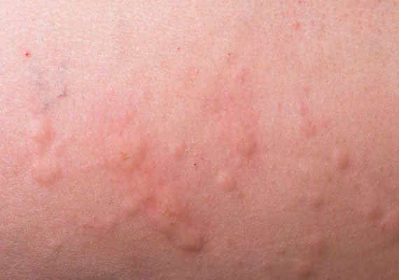 皮肤病的种类荨麻疹图片