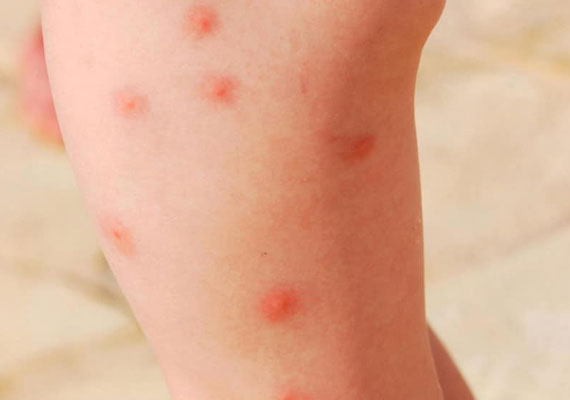 皮肤病红色疹子可能是昆虫叮咬