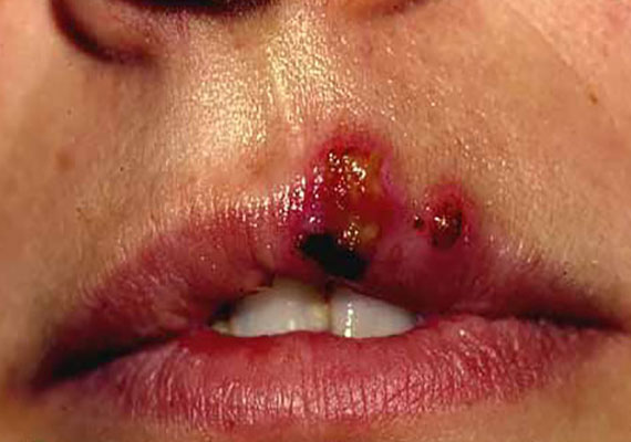 皮肤病种类唇疱疹症状图片