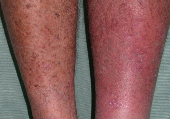 皮肤病种类蜂窝织炎症状图片