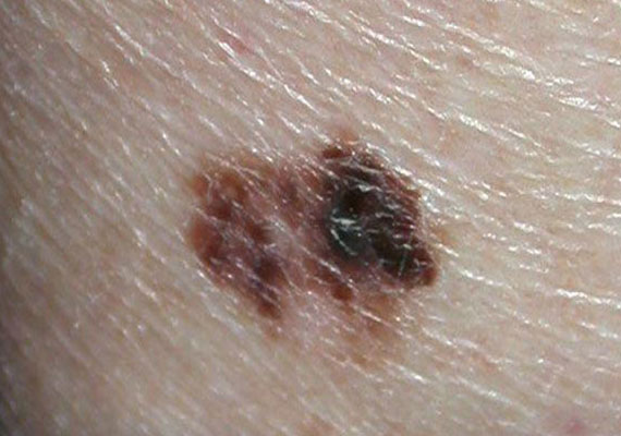 皮肤病种类黑色素瘤症状图片