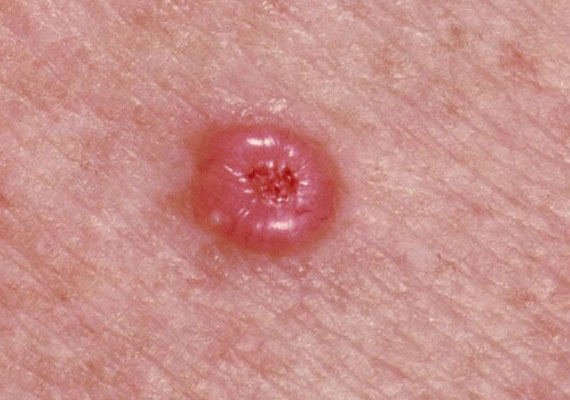 皮肤病种类基底细胞癌症状图片