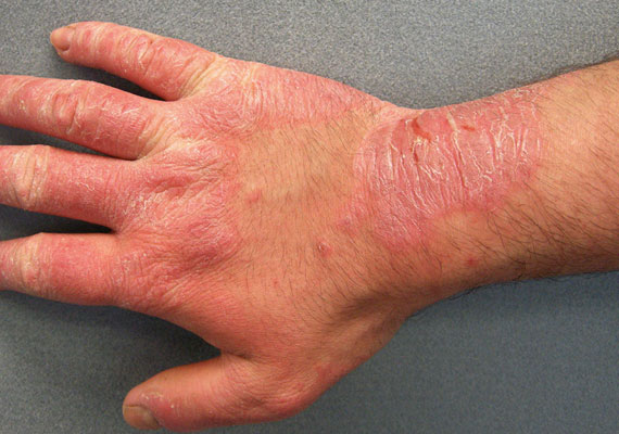 皮肤病种类接触性皮炎症状图片