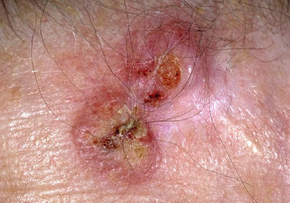皮肤病种类鳞状细胞癌症状图片