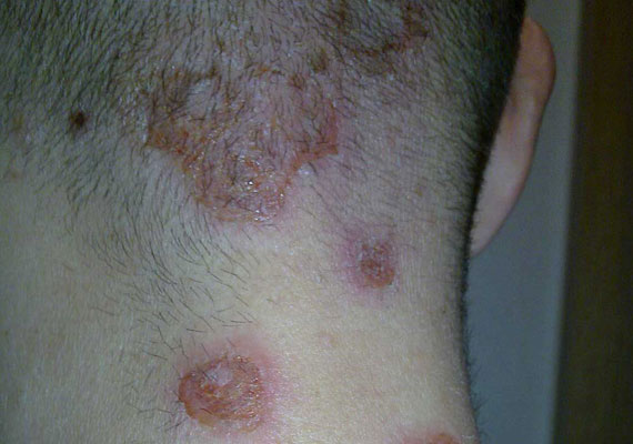 皮肤病种类脓疱疮症状图片