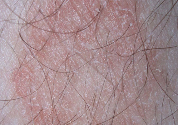 皮肤病种类癣症状图片