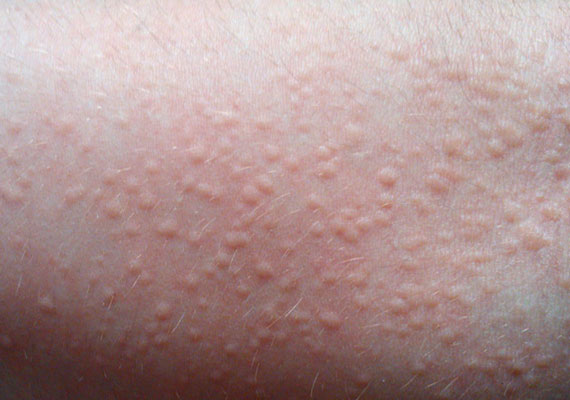 皮肤病种类荨麻疹症状图片