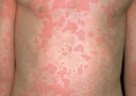 皮肤过敏荨麻疹图片