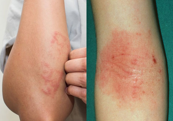 皮疹和湿疹的区别对比图片