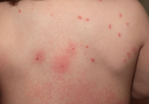 丘疹性荨麻疹能自愈吗