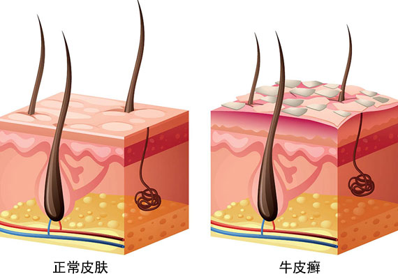 如何治疗牛皮癣的症状