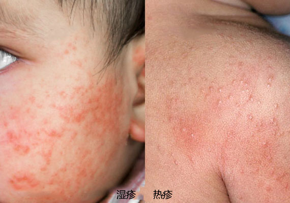 湿疹和热疹的区别对比图片
